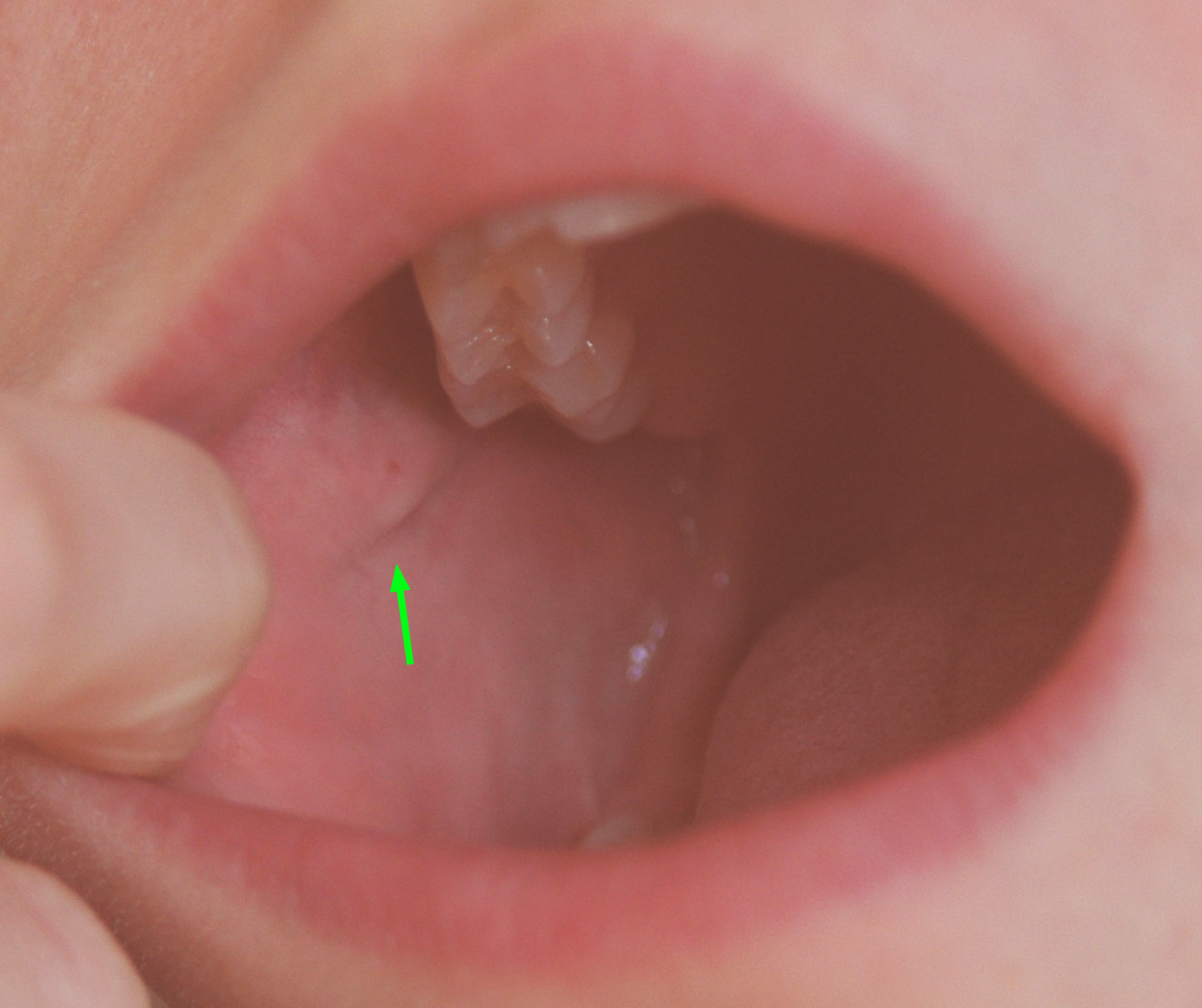 salivary-gland-terminology-anatomy-salivation-dry-mouth-drooling